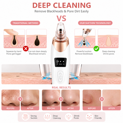 5-in-1 Electric Blackhead Remover